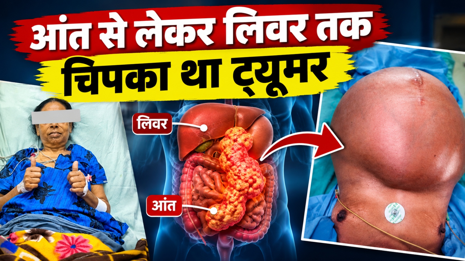 जयपुर के SMS अस्पताल में ऑपरेशन: पेट फूलता गया, अंदर ही अंदर बढ़ता रहा खतरा, वजन था 28.6 किलो जयपुर के SMS अस्पताल में ऑपरेशन: पेट फूलता गया, अंदर ही अंदर बढ़ता रहा खतरा, वजन था 28.6 किलो