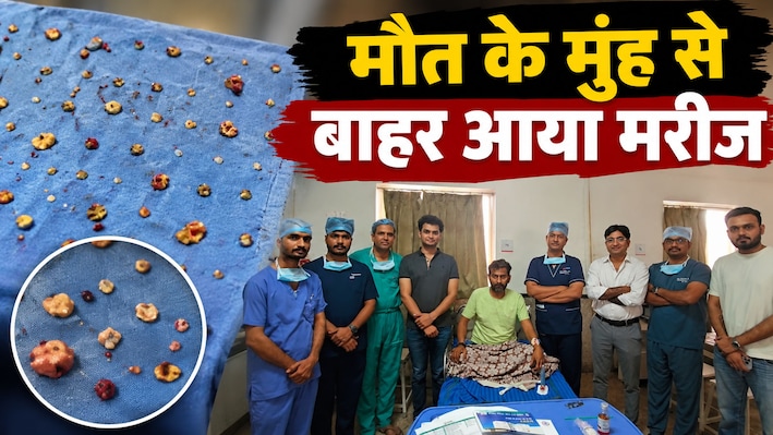 सांसें थाम देने वाली सर्जरी: मौत के मुंह से बाहर आया मरीज, फेफड़ों से निकाले गए 2,000 से ज्यादा सिस्ट्स!
