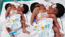 चौंक गए डॉक्टर भी! पेट एक और सिर दो, ओडिशा में अजूबे बच्चे का जन्म देख उड़े सबके होश