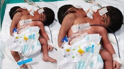 चौंक गए डॉक्टर भी! पेट एक और सिर दो, ओडिशा में अजूबे बच्चे का जन्म देख उड़े सबके होश