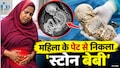 पेट में था कंकाल, बच्चा बन गया था पत्थर: तीन साल तक महिला को नहीं लगी भनक; ऑपरेशन से निकला दुर्लभ 'स्टोन बेबी'